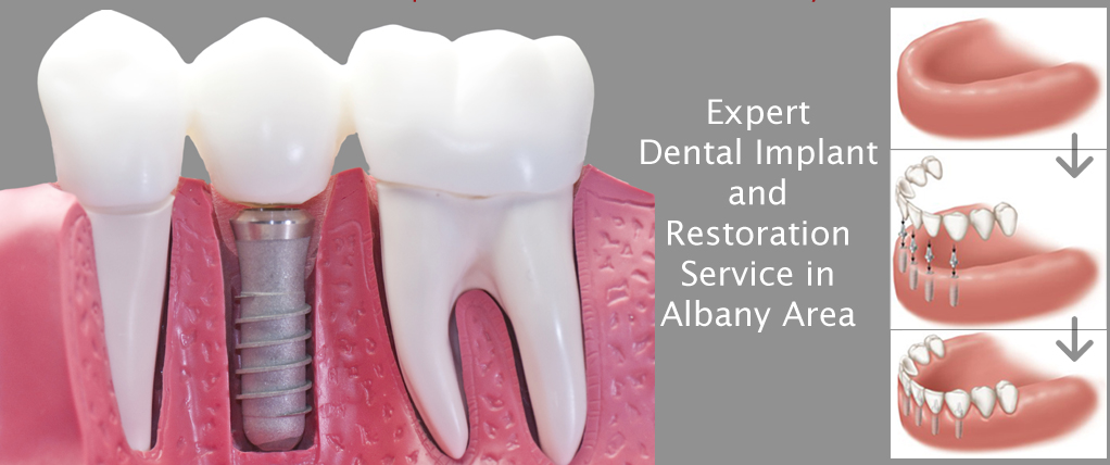 Dental Implants in Albany NY