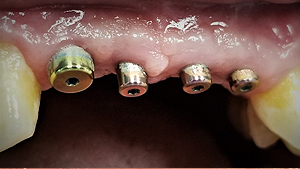 albany-dental-implant02